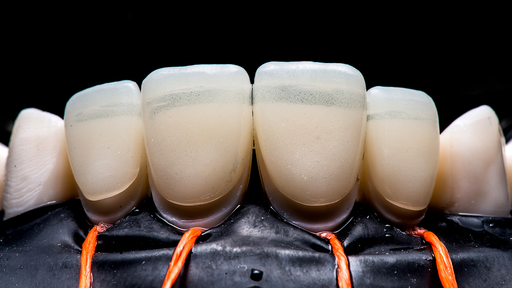 1. DSD Veneers: A Comprehensive Guide