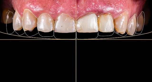 1. DSD Veneers: A Comprehensive Guide