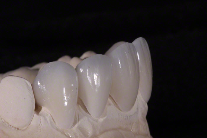 feldspathic veneers 6694dd08e7f52