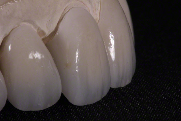 Feldspathic Veneers - A Comprehensive Guide to Material, Cost  Procedure