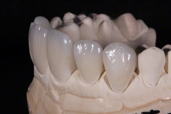 Feldspathic Veneers - A Comprehensive Guide to Material, Cost  Procedure